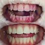 Как профессиональное окрашивание зубного налета помогает в заботе о зубах